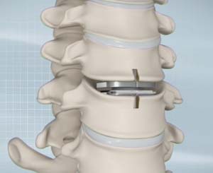 Cervical Disc Replacement